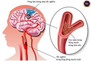 Những nguyên nhân gây đột quỵ sớm ở người trẻ