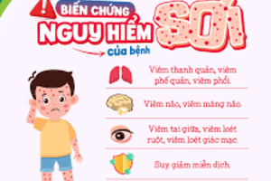 Cập nhập thông tin về tình hình bệnh sởi